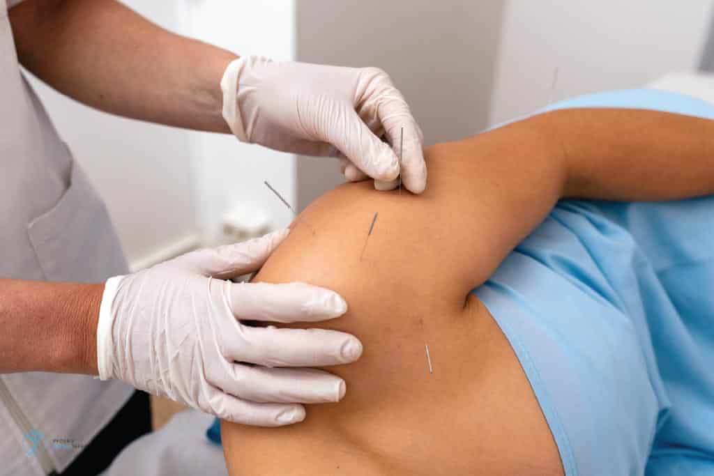 needling treatment on an arm